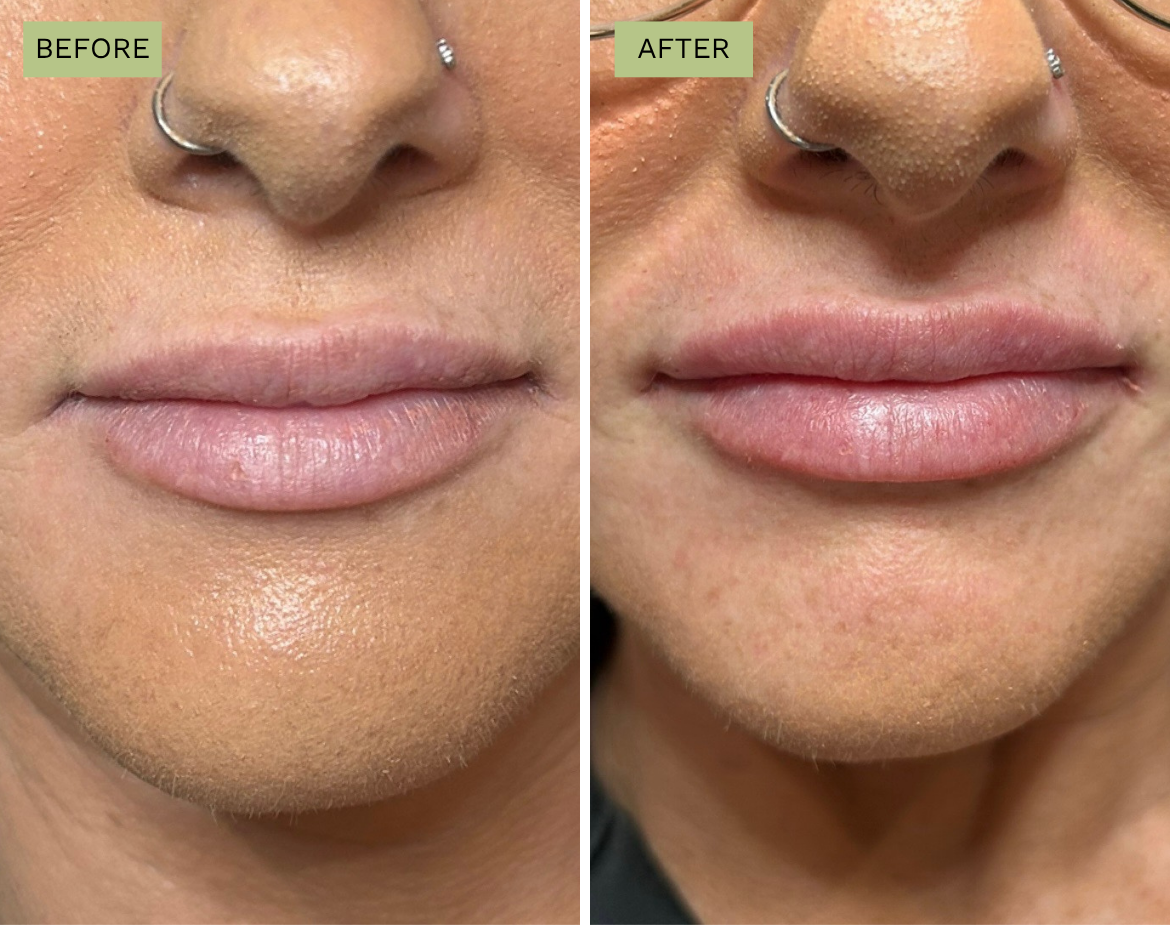 Elite Lips Filler with Juvederm